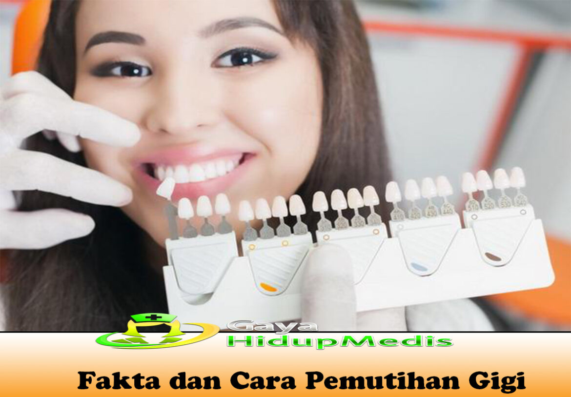 Fakta dan Cara Pemutihan Gigi