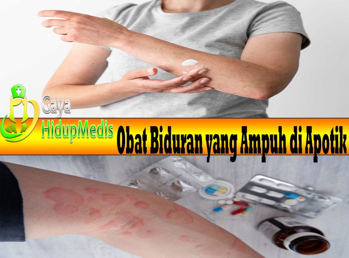Obat Biduran yang Ampuh di Apotik