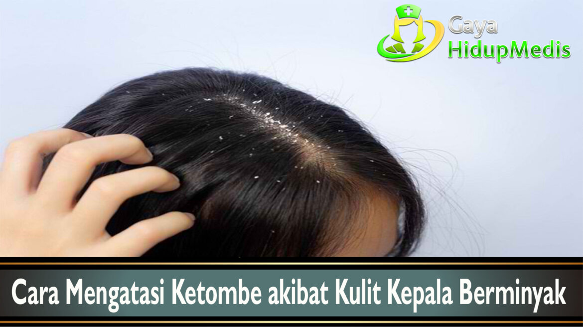 Cara Mengatasi Ketombe akibat Kulit Kepala Berminyak