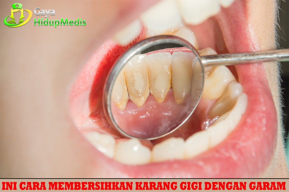 Ini Cara Membersihkan Karang Gigi dengan Garam