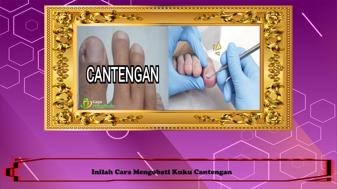 Inilah Cara Mengobati Kuku Cantengan