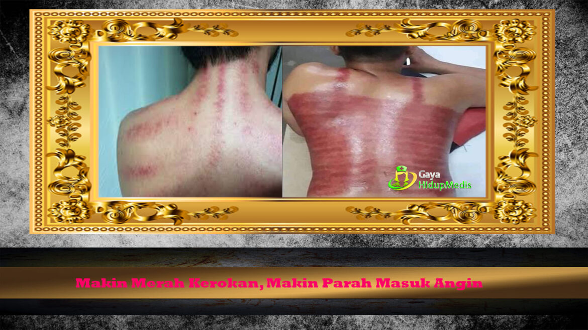Makin Merah Kerokan, Makin Parah Masuk Angin