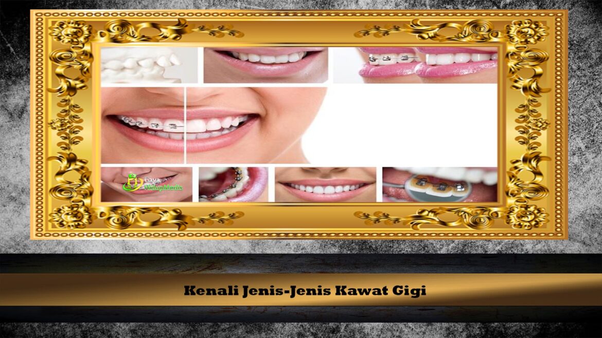 Kenali Jenis-Jenis Kawat Gigi